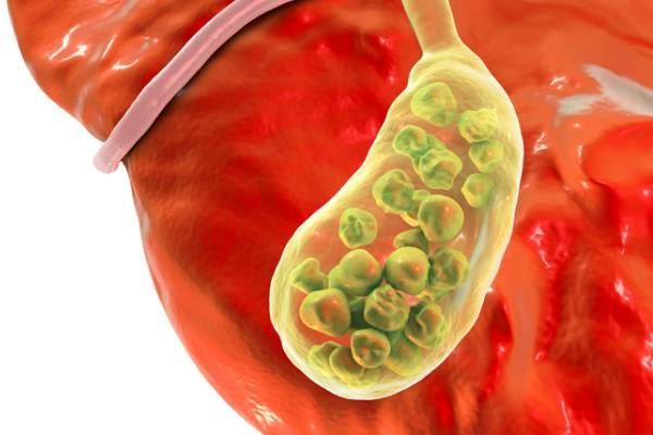 “Gallbladder Stone Surgery in Yamuna Vihar – Symptoms, Cost & Recovery Guide”